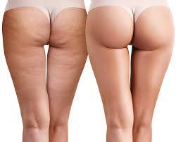 Soin radiofréquence pour éliminer la cellulite des fesses et des jambes